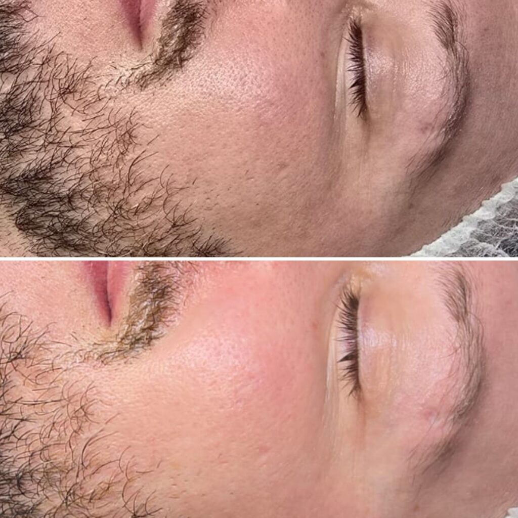1 sqt treatment results