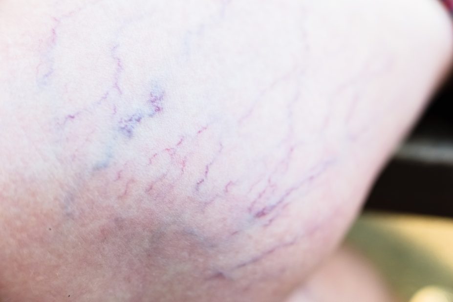 Detail of varicose veins on the leg of a seated woman.