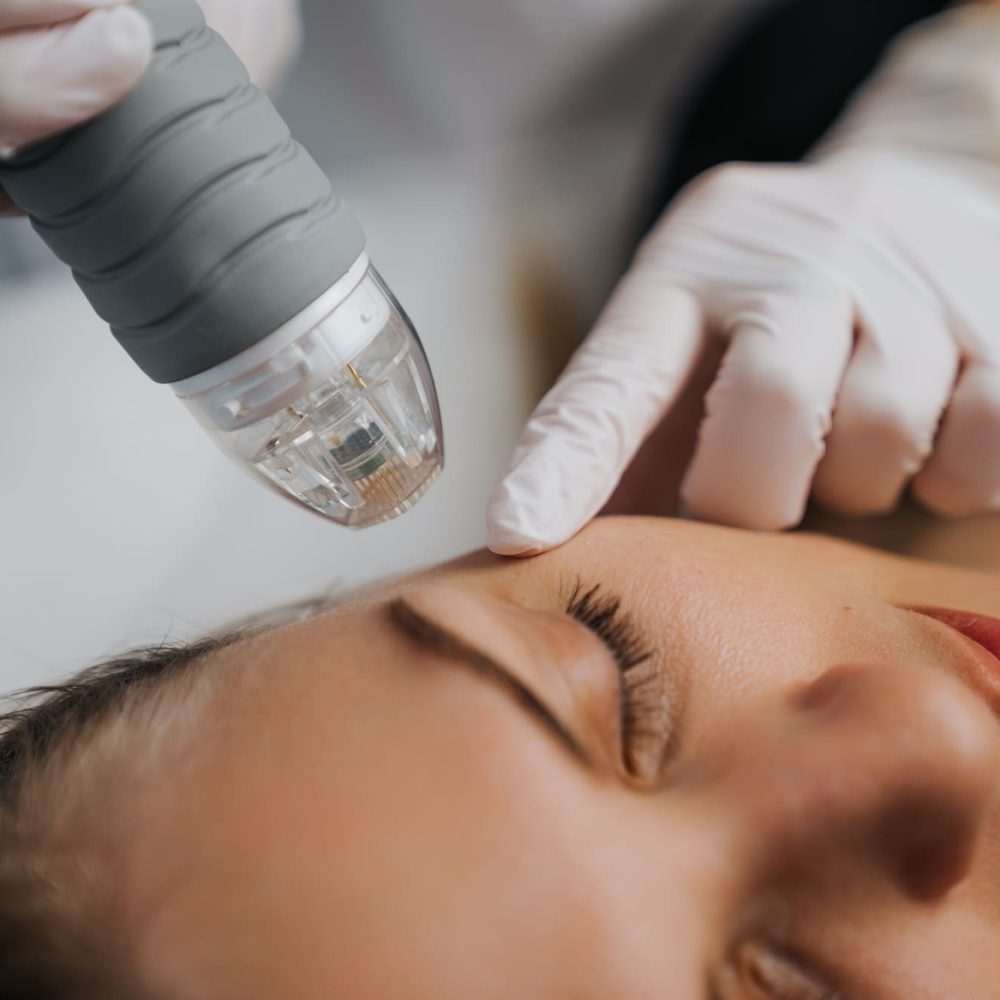 Microneedle RF lifting in a beauty salon. Big plan.