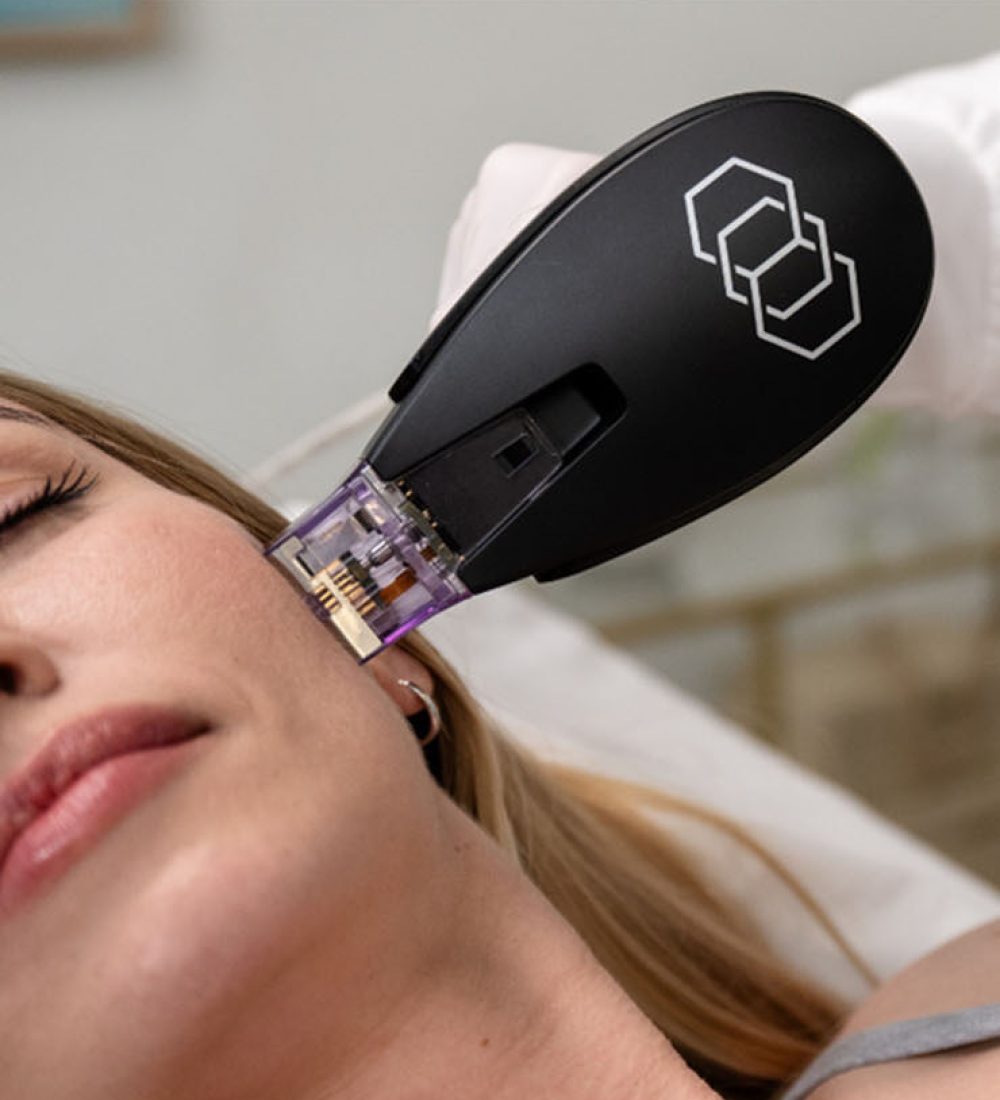 Morpheus8 for skin tightening in Carlow